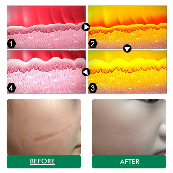 40W Co2 Laser Resurfacing Machine Vaginal Treatment ISO