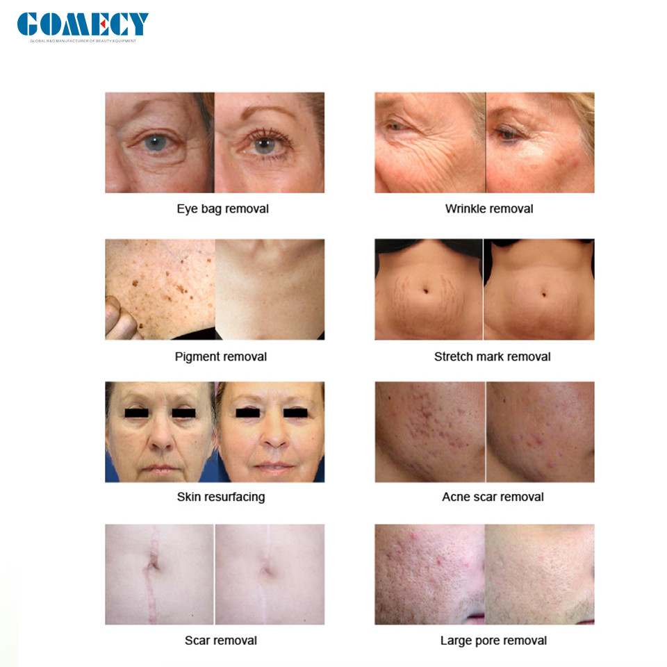 10.6μM Fractional CO2 Laser Skin Resurfacing Machine With True Color Touch LCD Screen