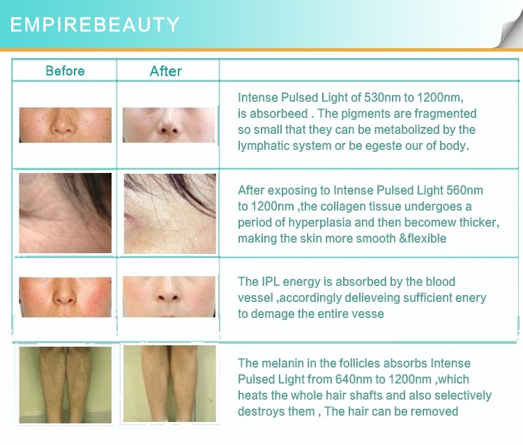 Portable SHR E-light Hair Removal Skin Rejuvenation
