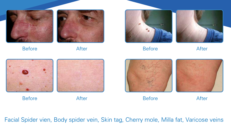 manufacturer laser 980 nm diode laser 30w therapy spider vein laser removal machine for sale