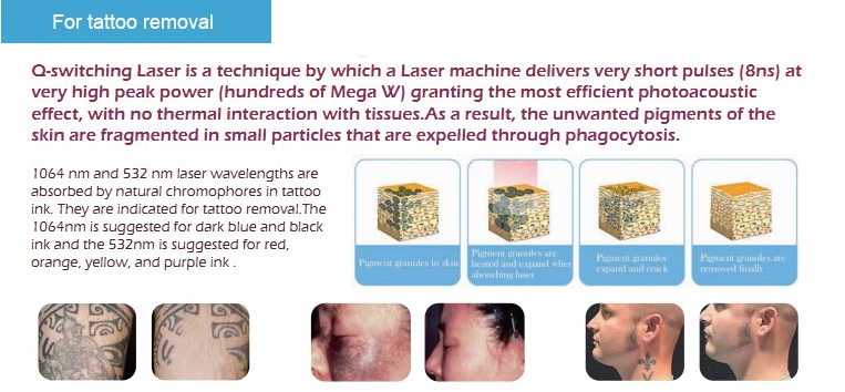 2017 Newest !! high quality Q switch nd yag laser for wrinkles removal machine , skin rejuvenation tattoo removal beauty