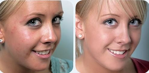 Skin maintenance microneedle nurse system Fractional radiofrequency micro needling