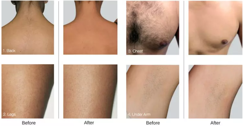 Diode Laser Beauty Equipment 755 808 1064 Hair Removal Skin Rejuvenation
