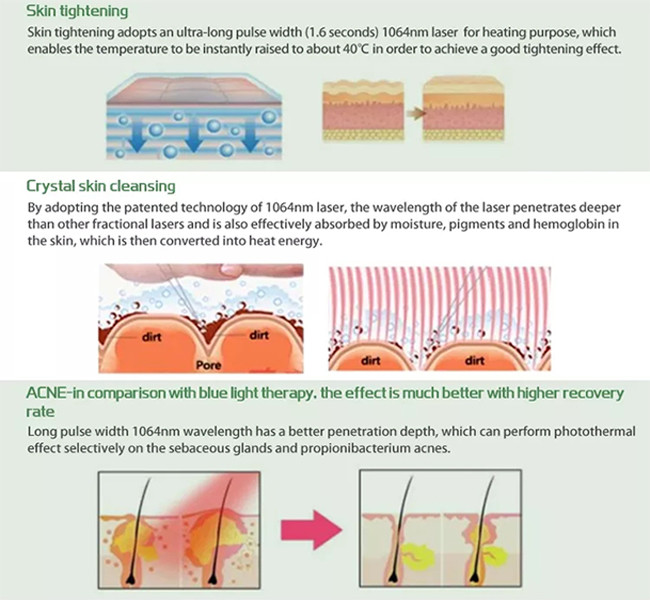 Nd YAG Alexandrite Laser Machine 1064 755 Laser Hair Removal Permanent