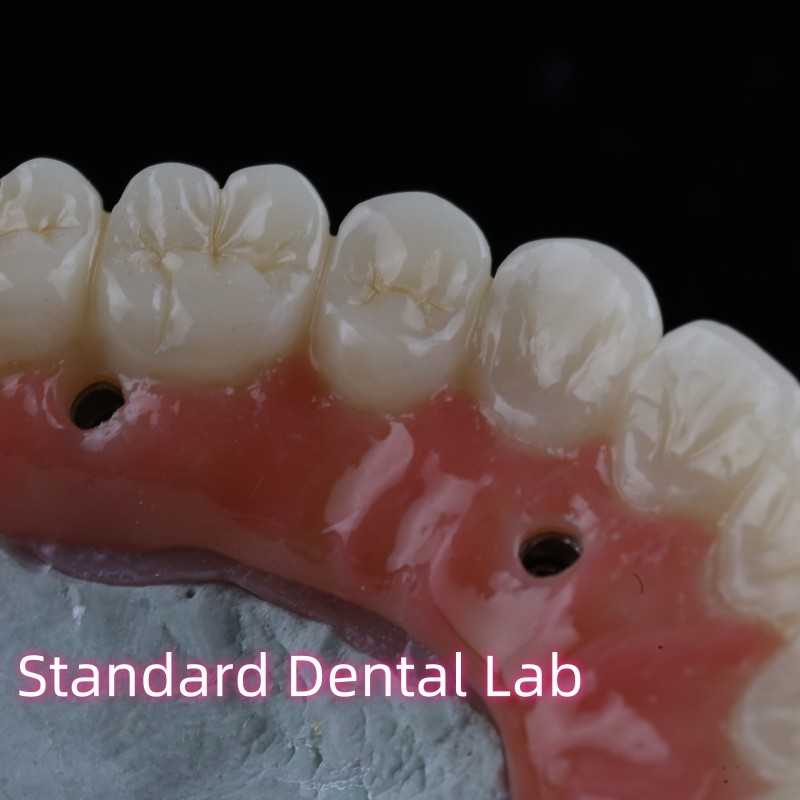 Dental Implant Crown PFZ Porcelain Layered Zirconia Screw Retained With Pink Gum