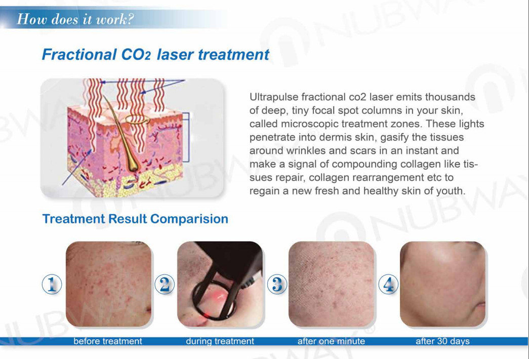 Fractional co2 laser for skin rejuvenation CO2 fractional laser machine with newest technolog