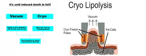 40% Off the most featured Cryolipolysis Slimming Machine Green Vertical