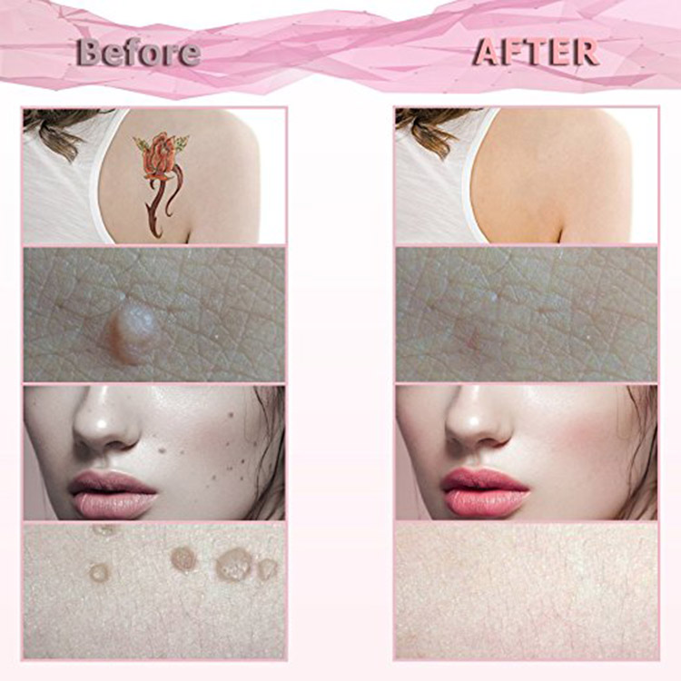 Vacuum Black Spot Remover Skin Machine Skin Tag Mole Electronic Removal Pen