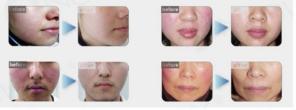 Varicose veins laser treatment machine spider veins on face removal professional high frequency machine
