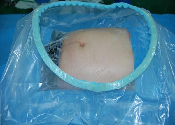EO Gas Sterile C Section Disposable Surgical Drapes