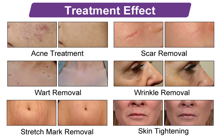 ZGV13-04 Latest Rf Tube Co2 Laser Skin Care Machine 30w Power Remove Acne Marks Remove Freckles And Scars Smooth Device
