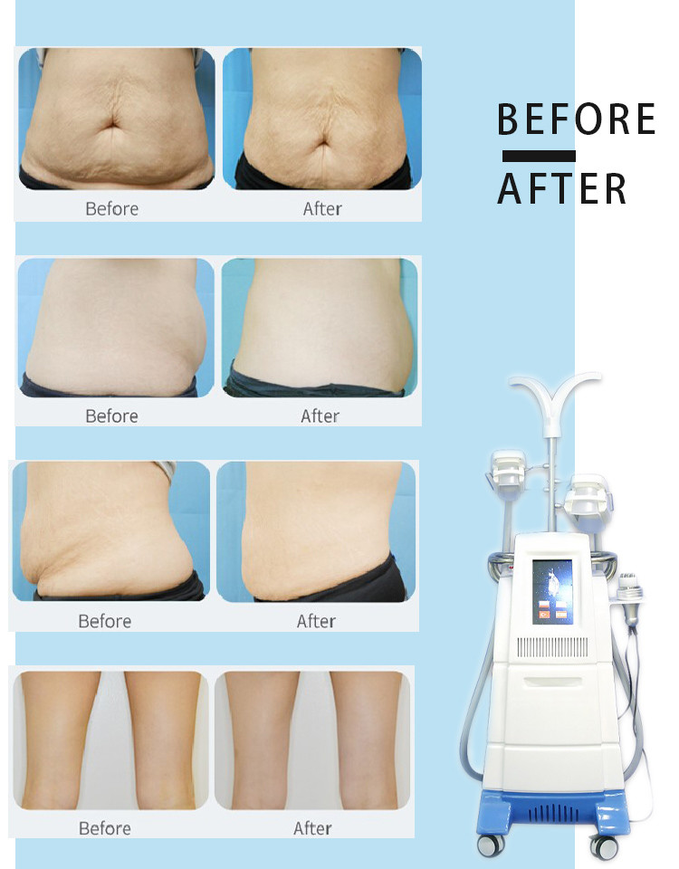 Cold Body Cryotherapy Slimming Criolipolyse 6 Hands Cool Tech Sculpting Shape Fat Freezing cryolipolysis Machine