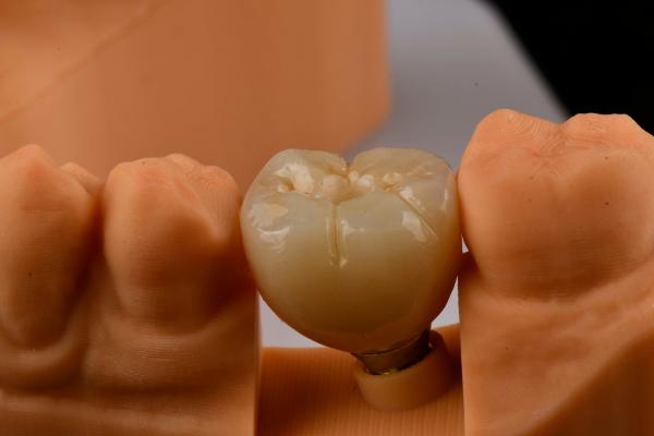 Oral Implantology Self Tapping Single Tooth Dental Implants With Internal Hex