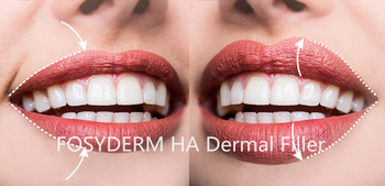 2ml High Quality Injectable Hyaluronic Acid Gel Dermal Lip Fillers