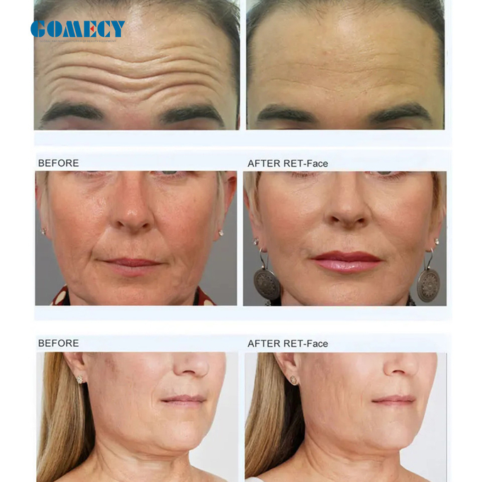 muscle focused for face antiage EMS Muscle Stimulator For Face Lifting Neck Lifting Skin Lifting And Firming