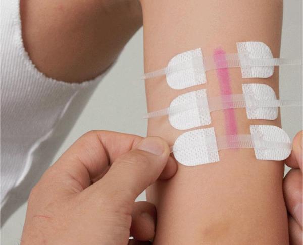Non Invasive Zip Stitch Suture Wound Closure Device Skin Closure Non Woven