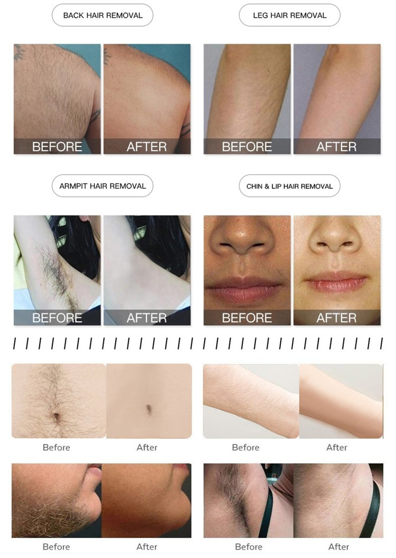 Spa 808 Nm Diode Laser Machine 2 In 1 Hair Removal And Picosecond Tattoo Removal