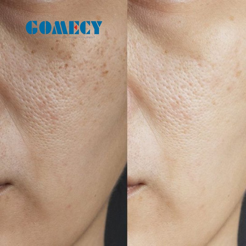 Professional Microneedle RF Machine with Adjustable Depth for Skin Rejuvenation and Scars Removal