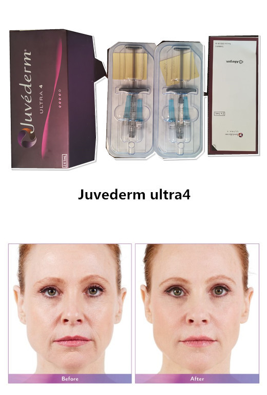 Ultra3 2*1ml Syringe Juvederm Hyaluronic Acid