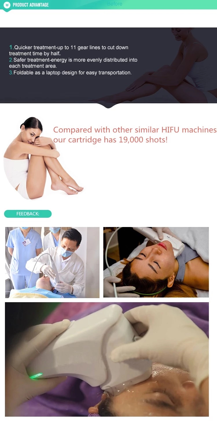 Professional 3d hifu face lifting machine/11 lines 3d hifu/ wrinkle removal hifu machine