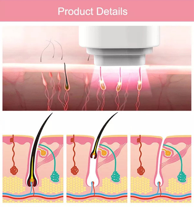 Blood Vessels IPL Hair Removal Machine 690nm Facial Hair Removal Laser Machine