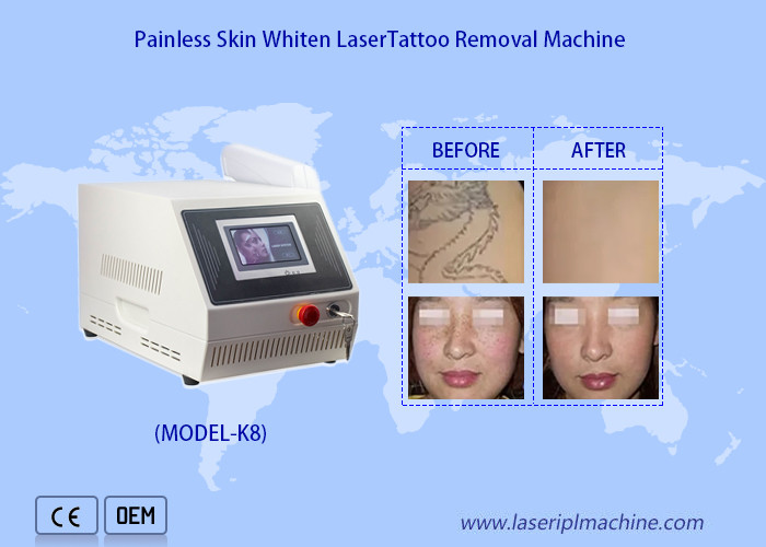 532nm Suitcase Laser Tattoo Removal Machine Q Switched Nd Yag