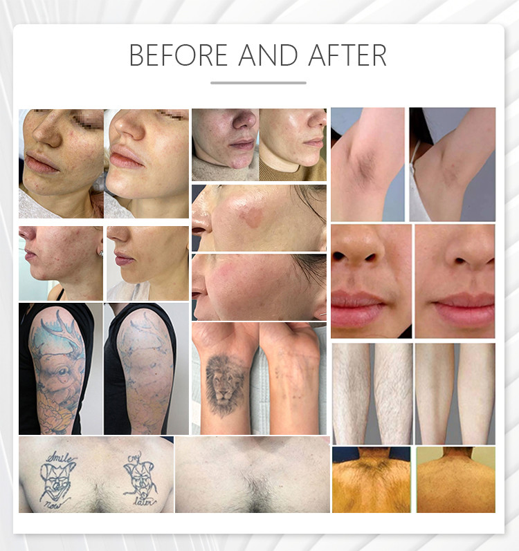 Big Power Good Effects Professional Ipl Hair Removal Machines Acne Removal Ipl Shr Hair Removal Machine