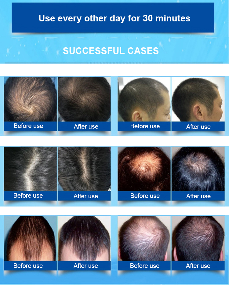 OEM LLLT Laser Hair Growth Caps 650nm Red Light Hat For Hair Regrowth
