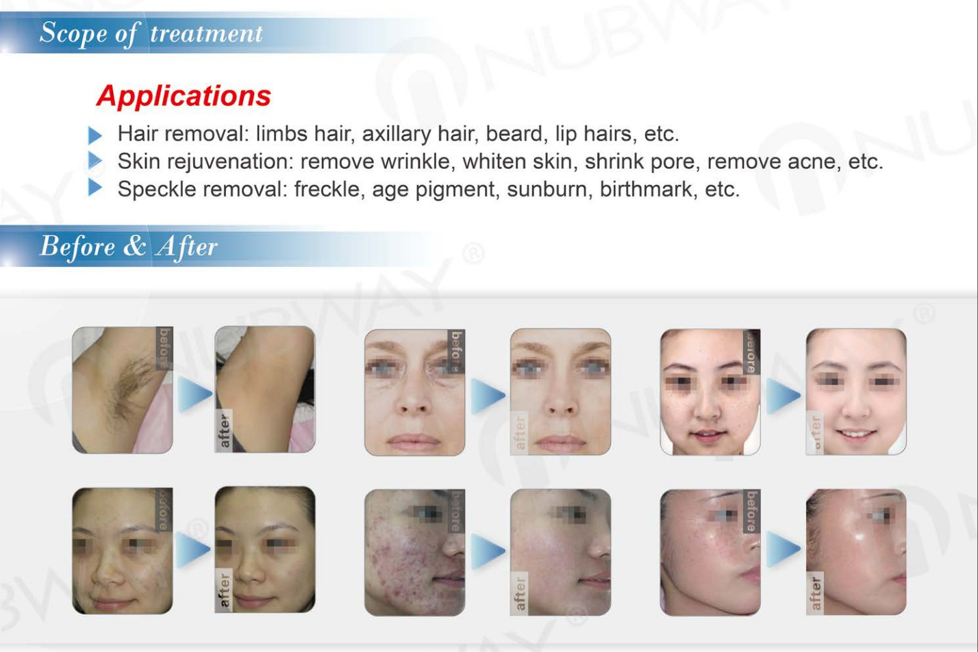 e-light ipl beauty equipment ipl laser hair removal machine for sale