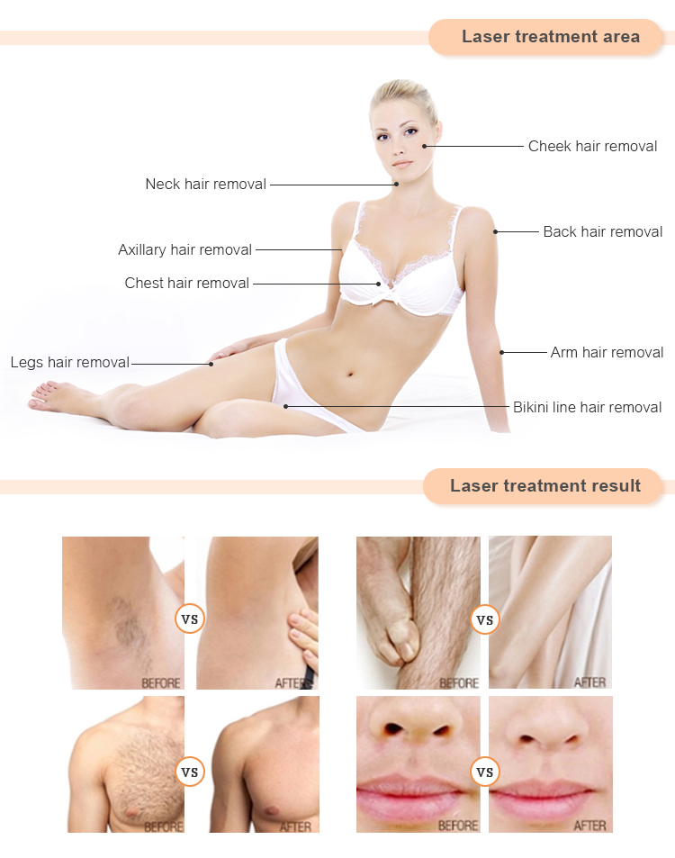 High Power 1600W Whitening Diode Laser Hair Removal Machine 3 Wavelength 755 808 1064