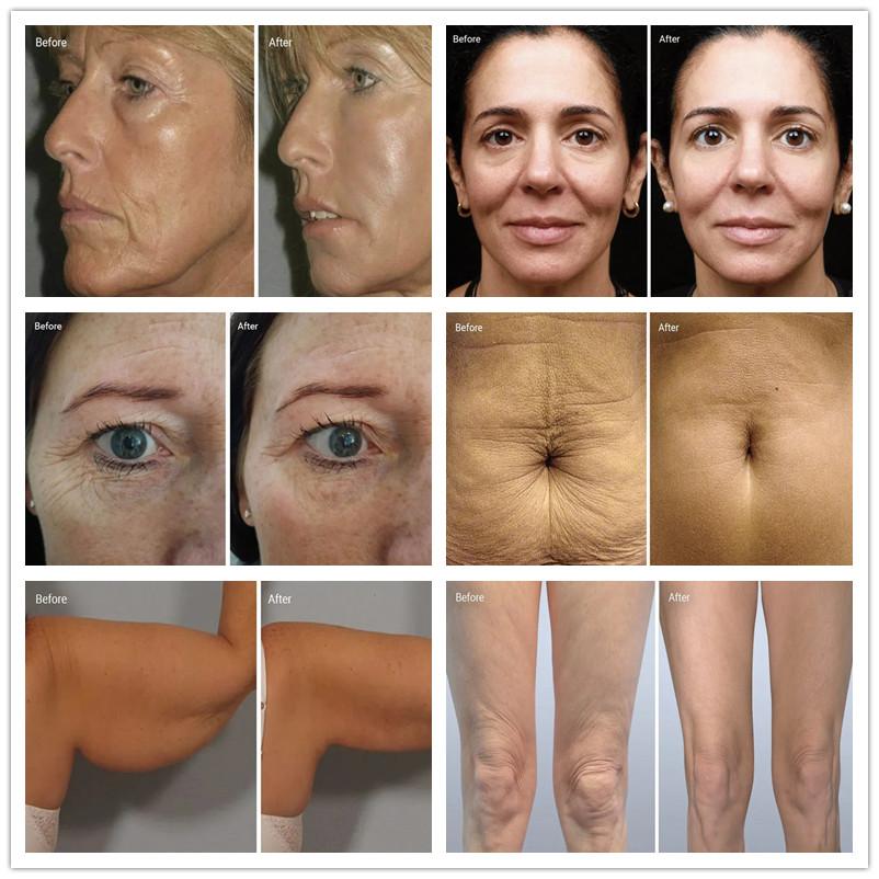 1.2MHz Anti Wrinkle Radio Frequency Skin Tightening Equipment