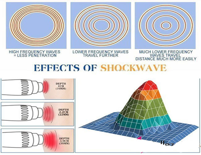 best 18 Tips shockwave therapy machine for ed treatment