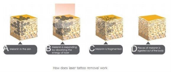 Clinic professional q switch nd yag laser tattoo removal system with big promotion