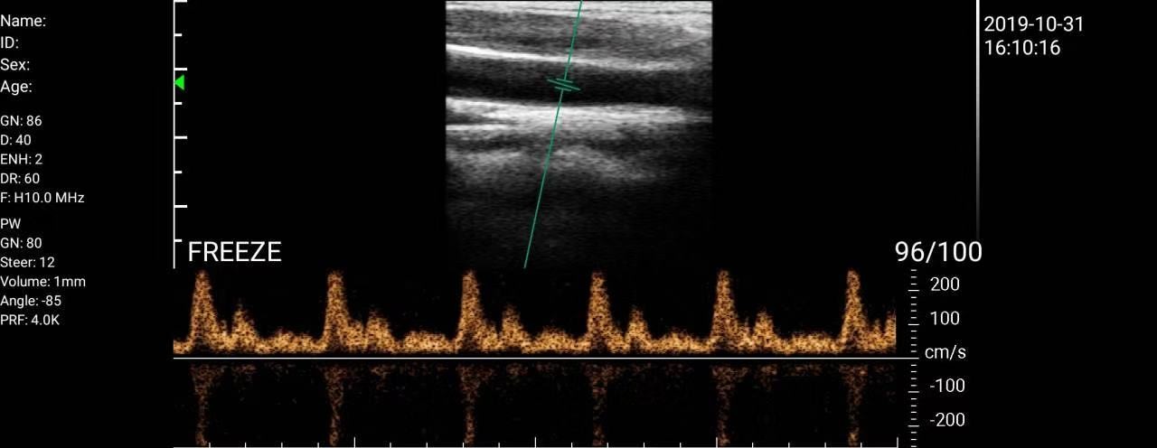 Wifi Portable Ultrasound Scanner Wireless Ultrasound Linear Probe, 7-10Mhz 128 elements