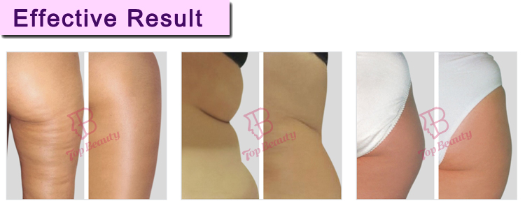 Therapy Machine Beauty Salon Vacuum System Roller Massage Anti Cellulite Vacuum Roller Rf Machine