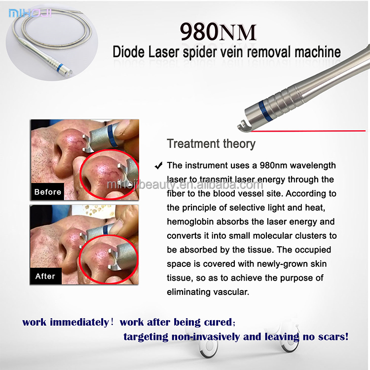 980nm Portable Vascular Removal Machine For Spider Vein Blood Vessels