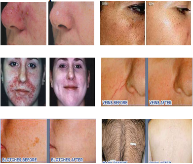 hot selling!!!Portable Professional IPL Hair Removal Machine for Skin Rejuvenation