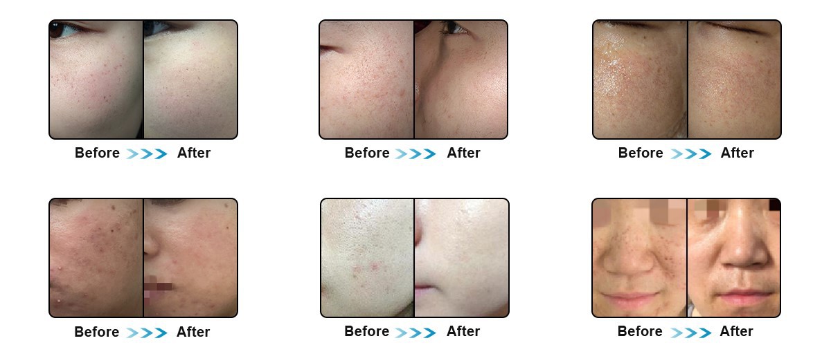 Multi-function Hair Removal Skin Rejuvenation Machine DPL