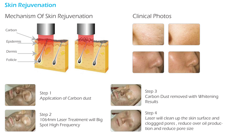 factory produced best korea lab all colors pico laser tattoo remover with Picosecond